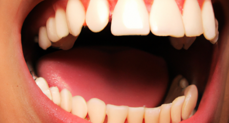 ¿Existe un límite de veces que se puede realizar un blanqueamiento dental?