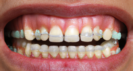 ¿Los enjuagues bucales son efectivos para personas con brackets removibles?